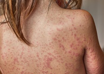 Measles Outbreak: Schools Move to Bar Unvaccinated Kids