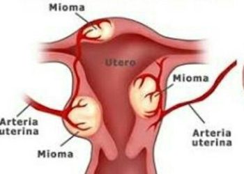 Amsal Sitepu Bocorkan Rencana dengan Istri untuk Promil Gagal Akibat Kasus Korupsi, Menangis
