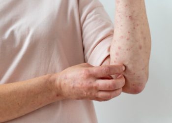 Bahaya Campak pada Orang Dewasa dan Ancaman Komplikasi yang Mengintai