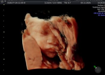 ‘We Were Already Grieving’: Heartbreaking News for Couple After Months of Losing Twin Baby